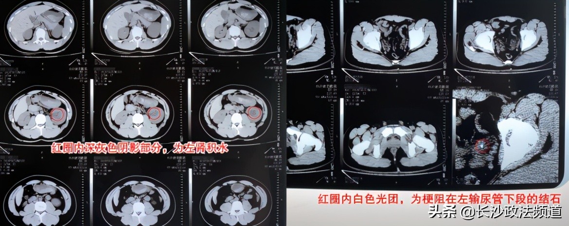 跑步排石反加重病情？大一男生小江的肾结石教训与王怀亮医生的建议